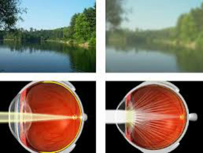 Advertiser.ie Understanding Cataract