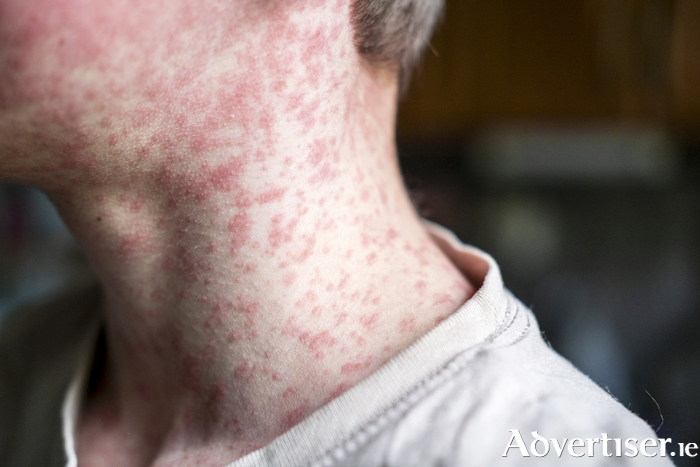 If you or your child shows signs of measles, you are advised to stay at home and contact your GP by phone.
Photo: iStock. 
